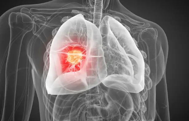 cancer pulmonar tratament experimental