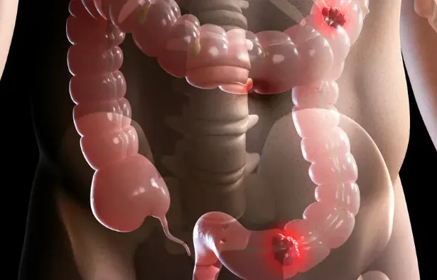 cancer2 cancer gastrointestinale