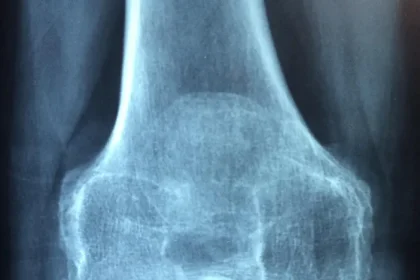 osteoporoza barbati MAI