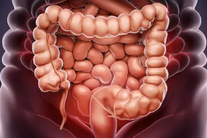 Cancerul - Cancerul de colon la tineri: cauzele alarmante descoperite de studii