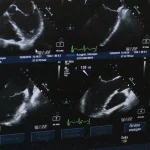 Decesul fetal cauză - Cauza decesului fetal descoperită de oamenii de știință: Află mai multe!